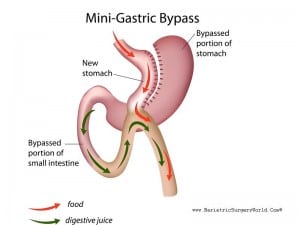 Omega Loop Gastric Bypass